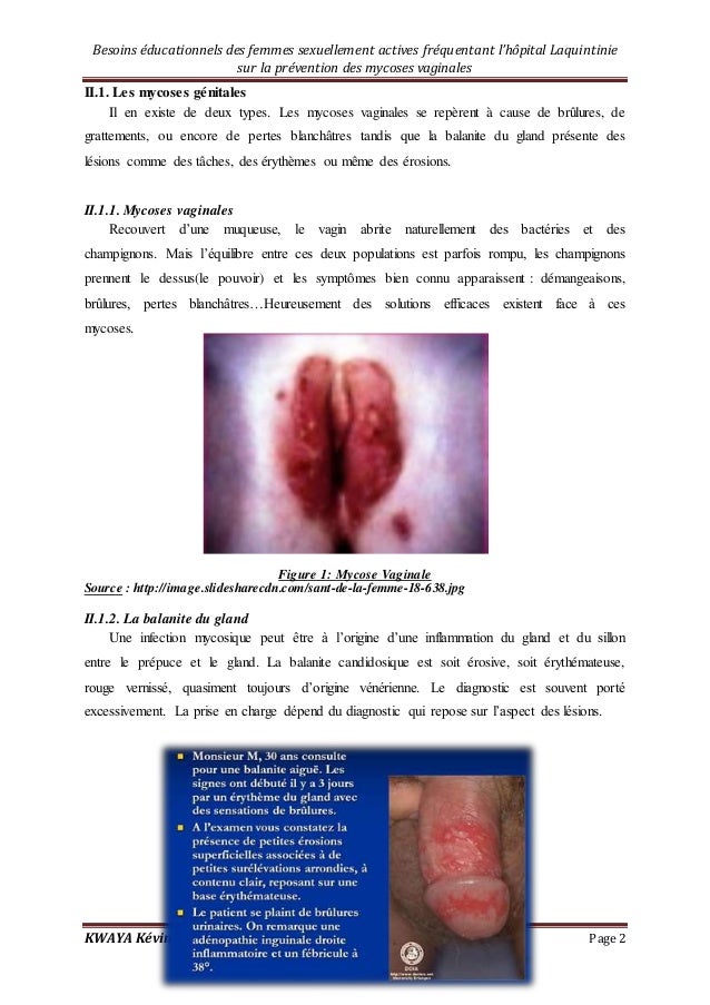 mycose vaginal femme mycose vaginal femme